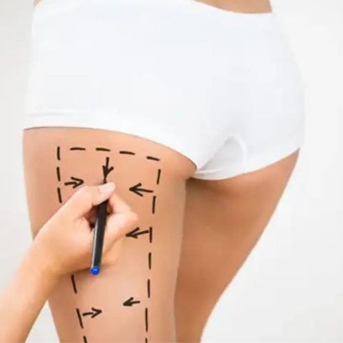 Hip Lift Surgery in Turkey 2025