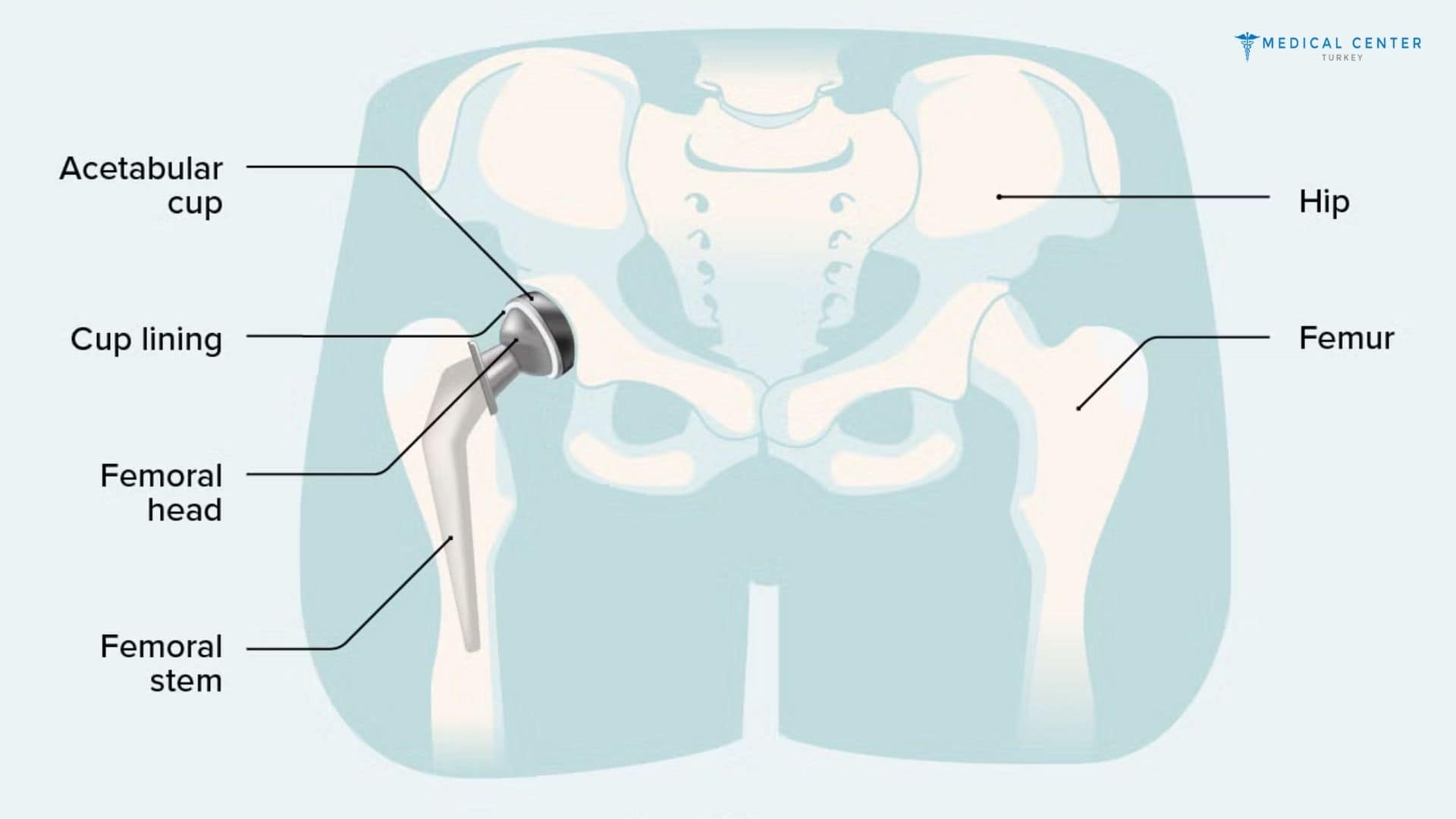 Hip Lift Surgery in Turkey 2025