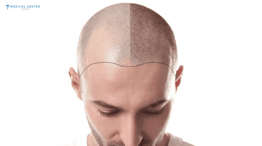 Is DHI Hair Transplant the Best Option for You in 2025?
