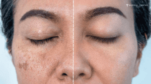 What Is Mesotherapy and Why Is It Popular in Turkey?