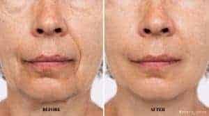 How Much Does Fat Transfer to Face Cost in Turkey ?