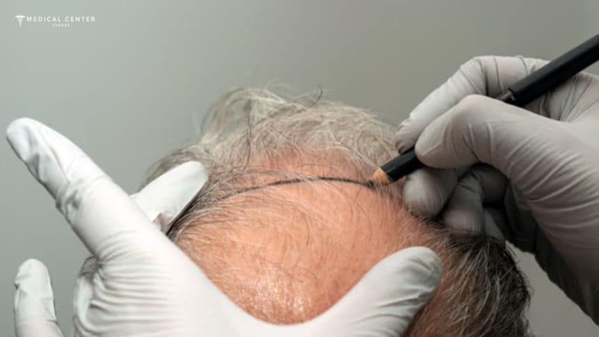 How Long Do Hair Transplants Last in Turkey?