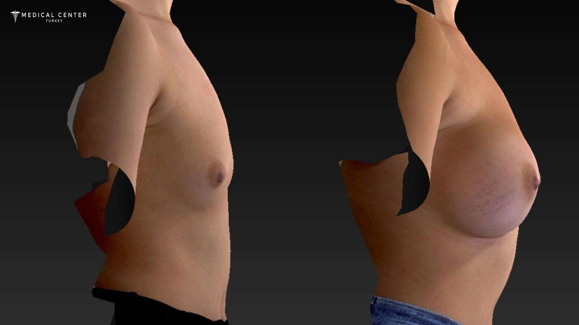 How Painful is Breast Reduction in Turkey 2025?
