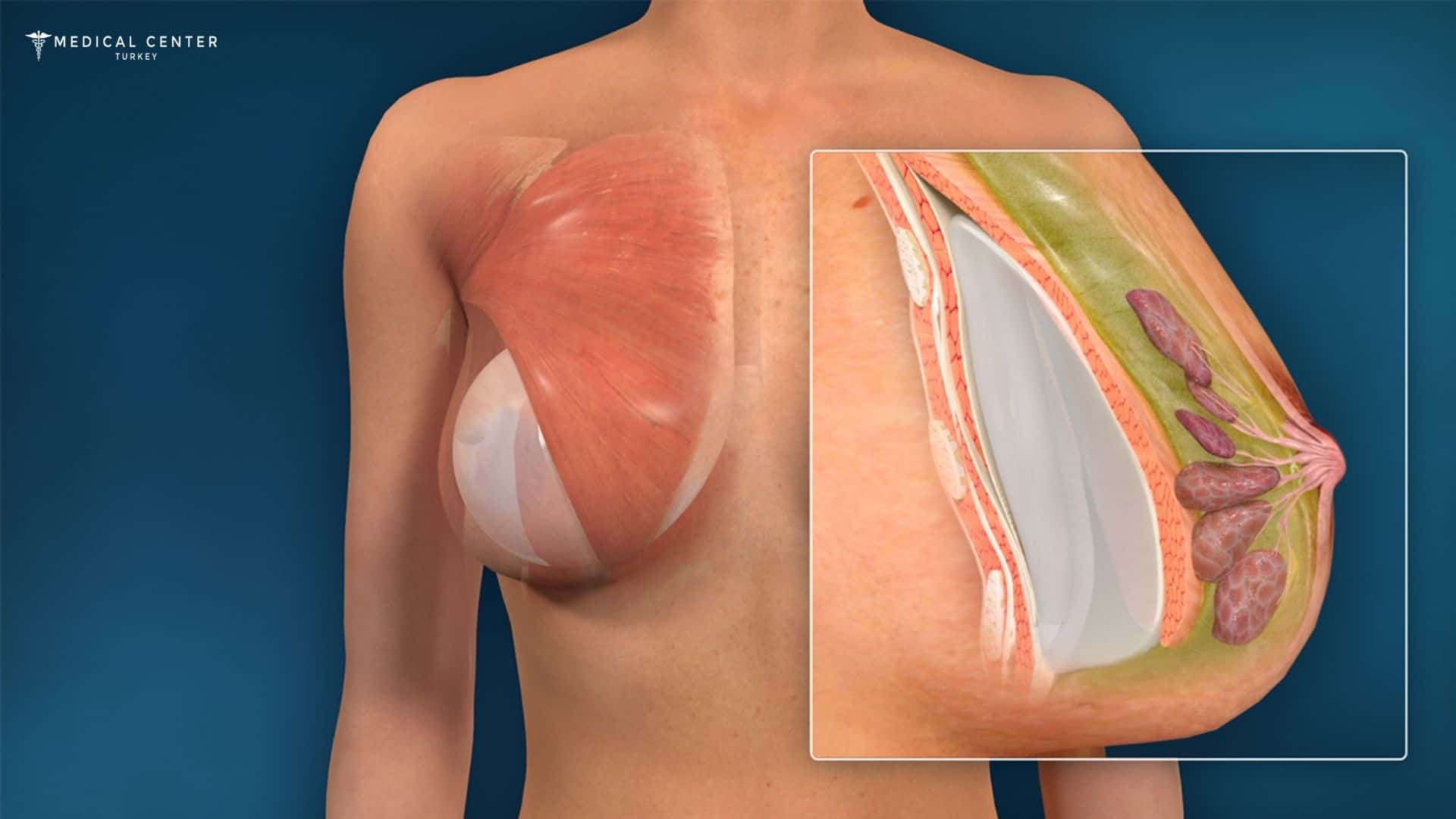 How Painful is Breast Reduction in Turkey 2025?