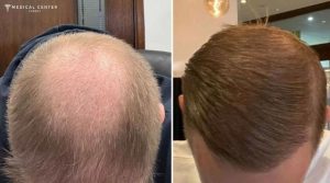 How Long Do Hair Transplants Last in Turkey ?