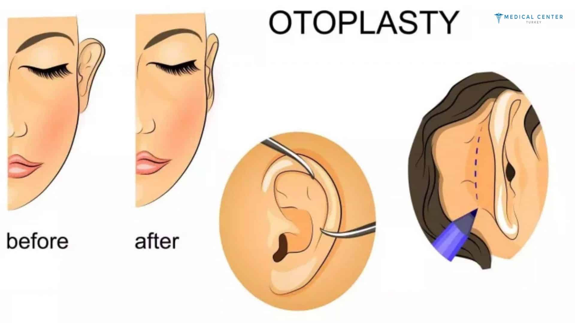 Can I Have Ear Surgery (Otoplasty) in Turkey?