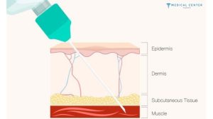How Often Should I Get Botox Injection in Turkey?