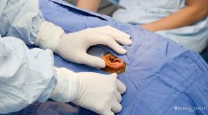 How Long is the Recovery for Ear Correction in Turkey?