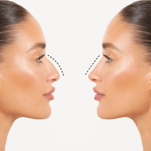 Why Choose Turkey For a Nose Job?