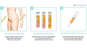 A Comprehensive Guide to Fat Injection Procedures in 2025