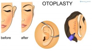 How Long is the Recovery for Ear Correction in Turkey?