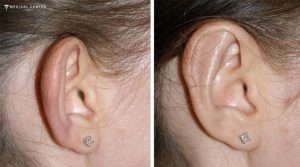 How Long is the Recovery for Ear Correction in Turkey?