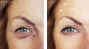 How Often Should I Get Botox Injection in Turkey?