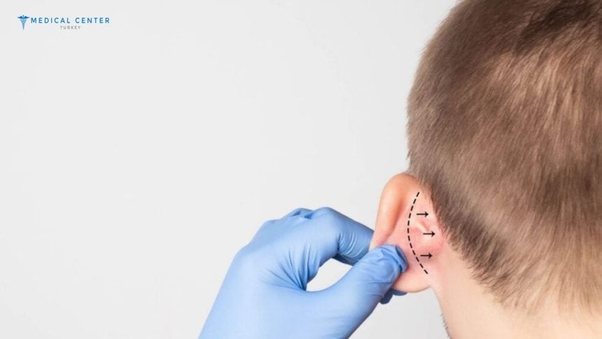 How Long is the Recovery for Ear Correction in Turkey?
