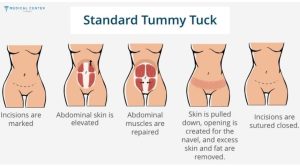 Why Do Patients Travel to Turkey for Tummy Tucks?