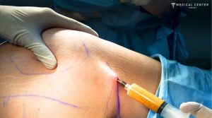 A Comprehensive Guide to Fat Injection Procedures in 2025