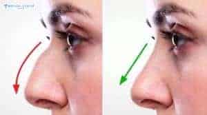 Why Is Preservation Rhinoplasty So Popular in 2026?