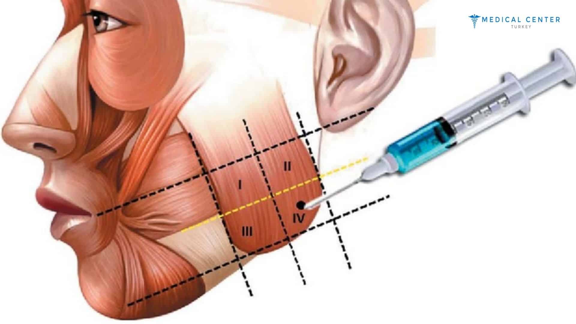 Best Botox Alternatives Right Now in Turkey