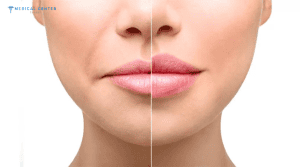 Do Lip Fillers Still Look Natural in 2026?