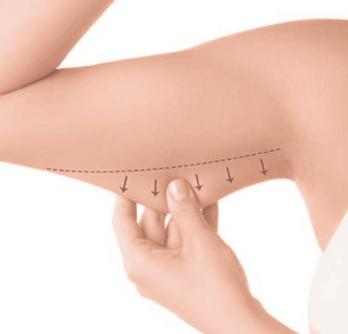 What Are the Expected Result of an Arm Lift in Turkey