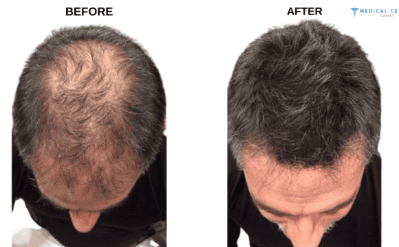 Manish's Hair Transplant Experiences in Turkey