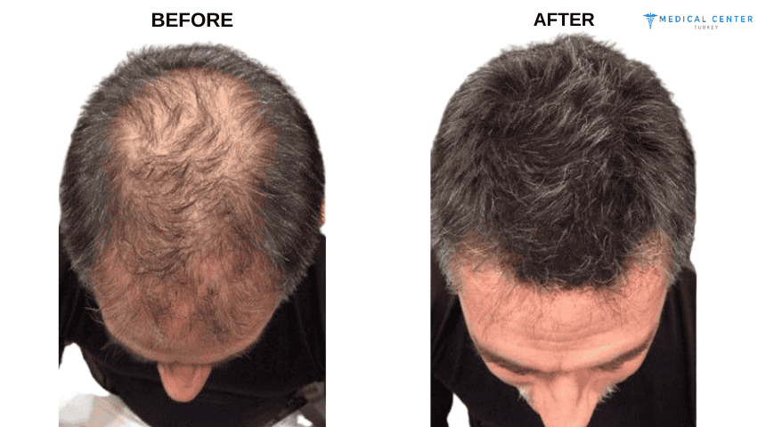 Manish's Hair Transplant Experiences in Turkey