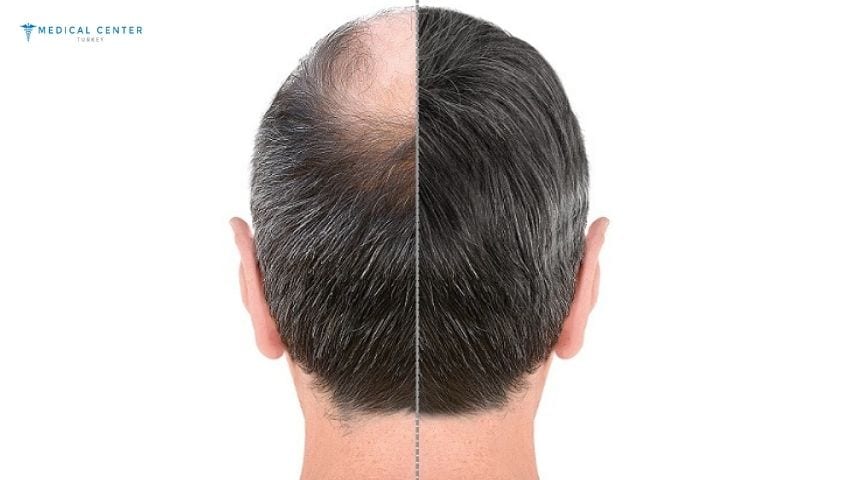 What is New in Hair Transplants in 2026?