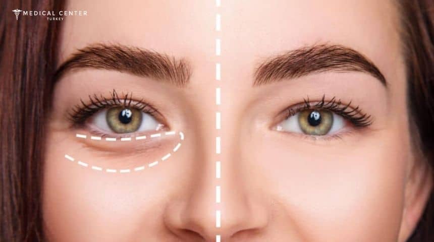 What Should You Know About Under Eye Fillers in 2026?