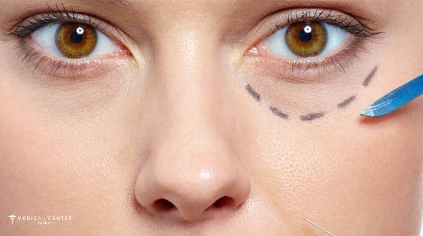 What Should You Know About Under Eye Fillers in 2026?