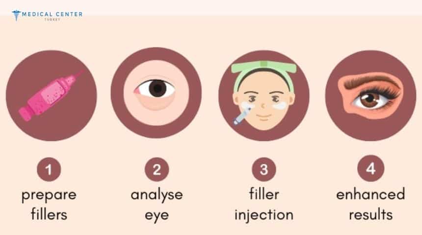 What Should You Know About Under Eye Fillers in 2026?