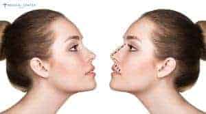 Is Turkey Still The Best Place For Nose Jobs?