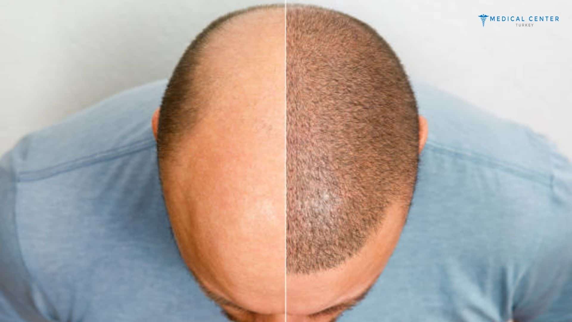 When Will You See Results After a Hair Transplant?