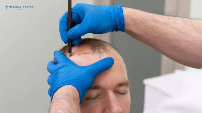 Why Does Turkey Still Delivers Top Results in Hair Transplants?