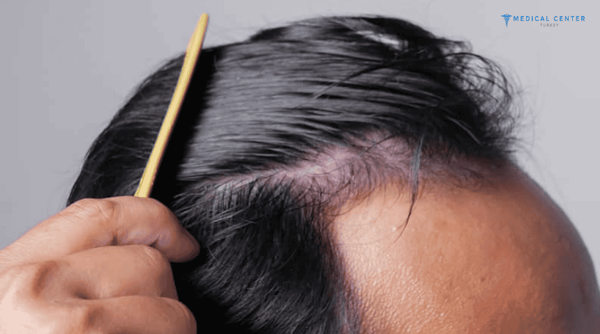 Paul's Hair Transplant Experience in Turkey