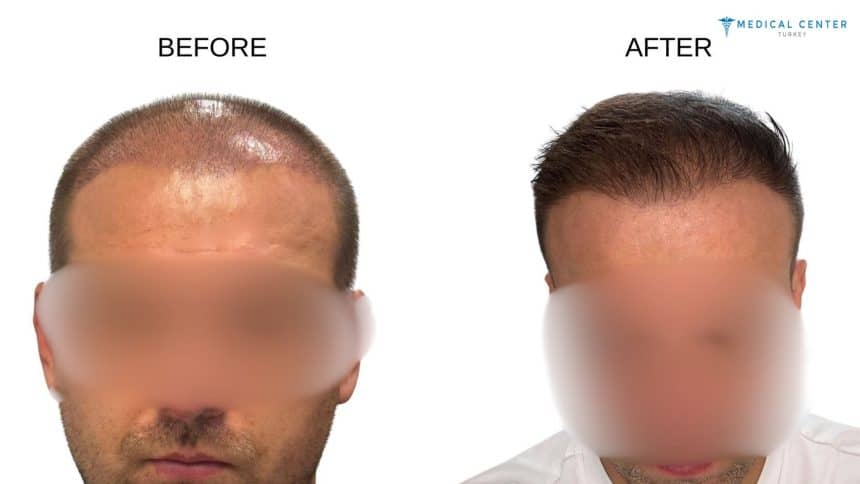 Canit’s Hair Transplant Experience in Turkey Canit’s Hair Transplant Experience in Turkey