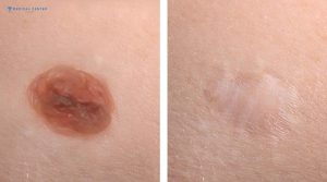 Is Mole Removal Still Popular in 2026?