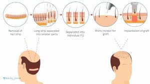 Which Hair Transplant Technique Works Best in 2026?