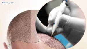 Which Hair Transplant Technique Works Best in 2026?