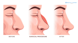 James’s Rhinoplasty Experiences in Turkey