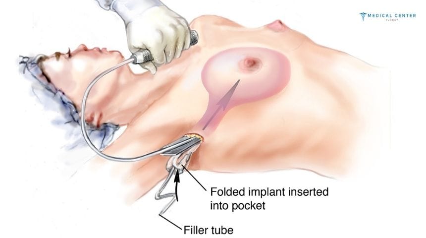 All Options For Breast Augmentation