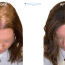 Olivia's Hair Transplant Experiences in Turkey