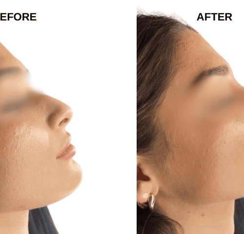 Sophia’s Rhinoplasty Experiences in Turkey Sophia’s Rhinoplasty Experiences in Turkey
