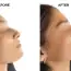 Sophia’s Rhinoplasty Experiences in Turkey