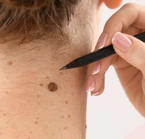 Is Mole Removal Still Popular in 2026?