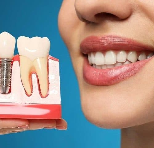Which Dental Implant Option Is Best for You?