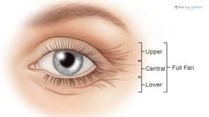 Eye Botox For a Fresher Look in Turkey