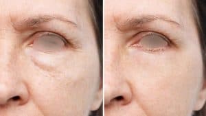 Eye Botox For a Fresher Look in Turkey