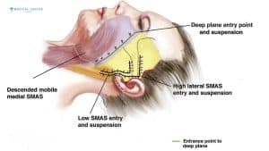 Why Deep Plane Facelifts are Trending?