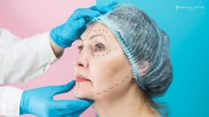 Why Deep Plane Facelifts are Trending?