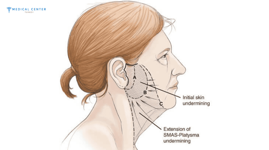 What’s New in Facelift Surgery in Turkey?